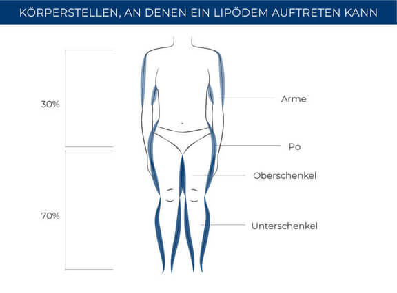 Körperstellen Lipödem, Lipödem Behandlung München