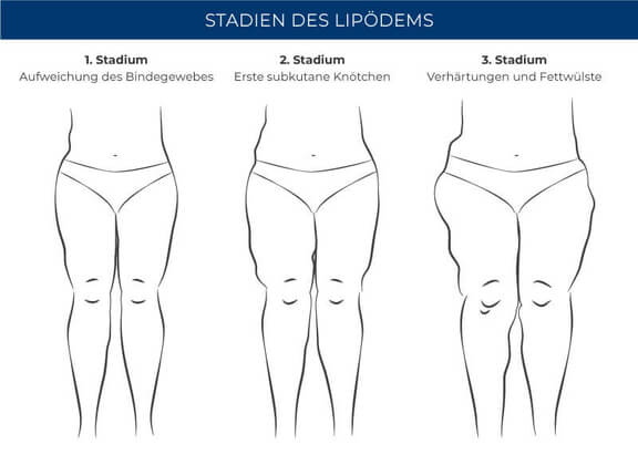 Stadien Lipödem, Dr. Michael Cerny, Lipödem Behandlung München