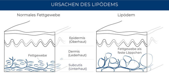 Ursachen Lipödem, Dr. Michael Cerny, Lipödem Behandlung München