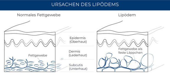 Ursachen Lipödem, Lipödem Behandlung München